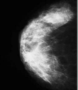 Dense breast tissue, as seen in this mammogram, can mask cancer lesions.